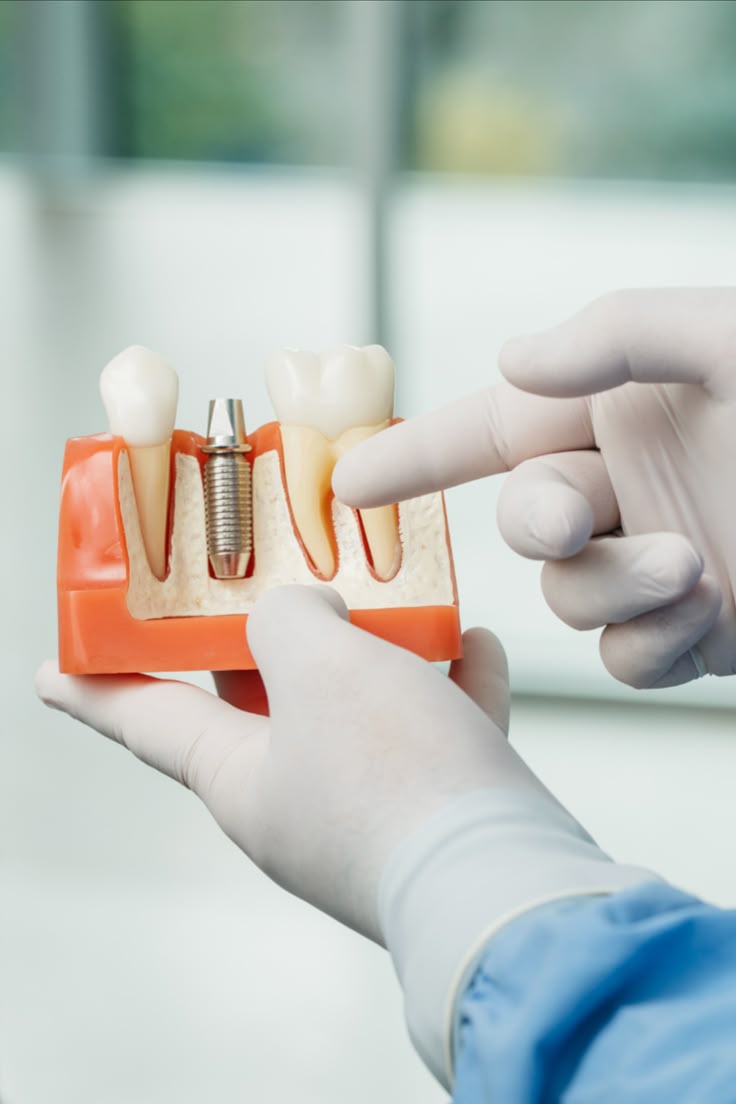 Dental Implants Kampala